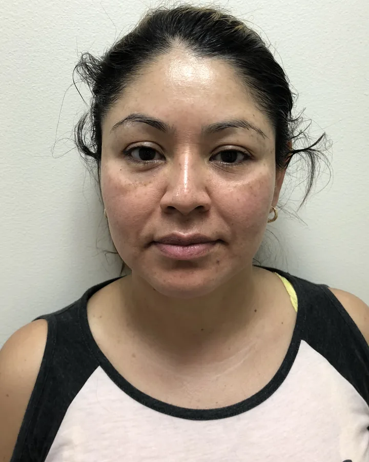 Microneedling Face & Neck Refresh — Microneedling — before photo