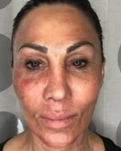 Butterfly Facelift Full-Face Refresh — Butterfly Facelift — after photo