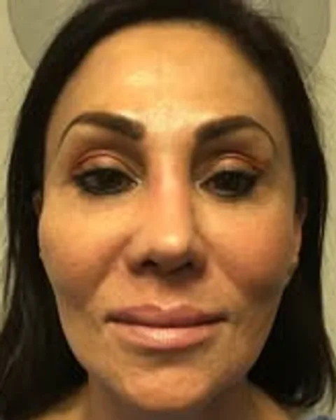 Butterfly Facelift Full-Face Refresh — Butterfly Facelift — before photo