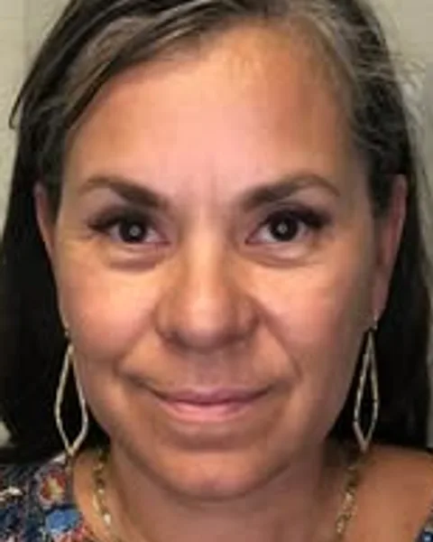 Butterfly Facelift Full-Face Refresh — Butterfly Facelift — before photo