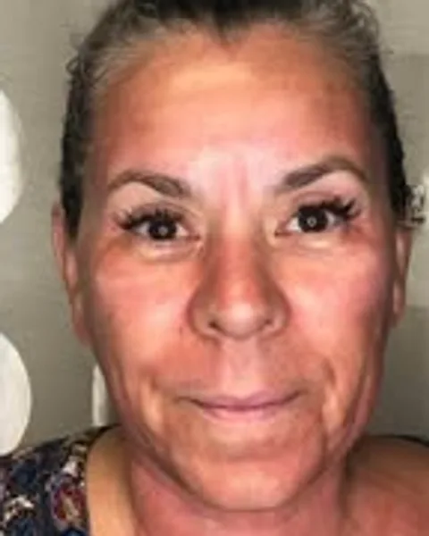 Butterfly Facelift Full-Face Refresh — Butterfly Facelift — before photo