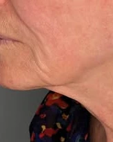 Jawline & Neck Rejuvenation — Butterfly Facelift — after photo