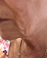Jawline & Neck Rejuvenation — Butterfly Facelift — before photo