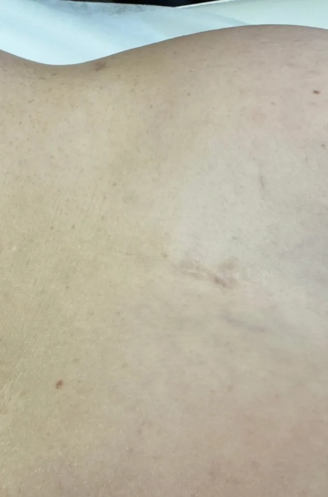The same area showing softened, faded scar tissue
