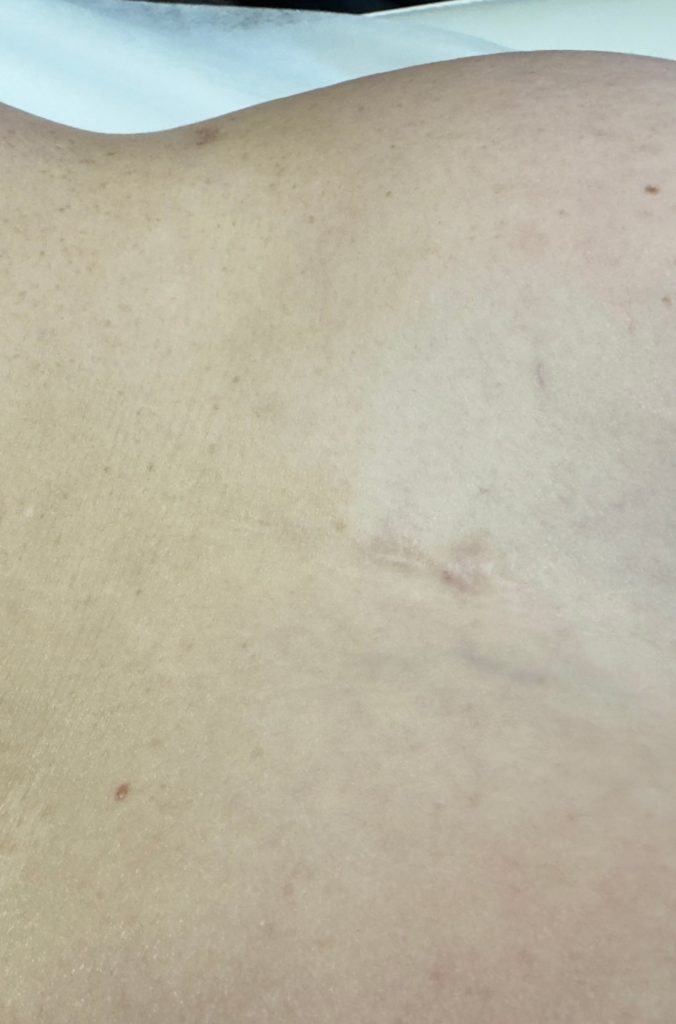 The same area showing softened, faded scar tissue