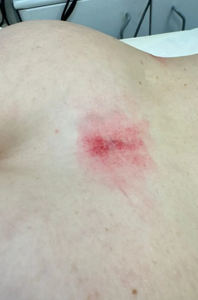 Liposuction scar on a client's back before non-invasive remodeling