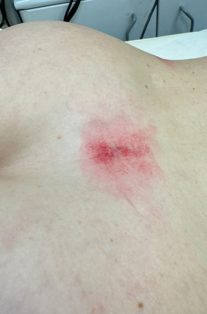 Liposuction scar on a client's back before non-invasive remodeling