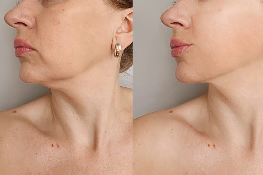 Non-surgical neck tightening treatment in Newport Beach