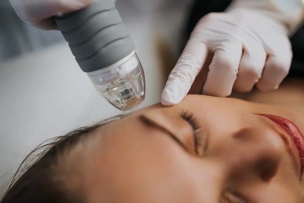 RF Microneedling