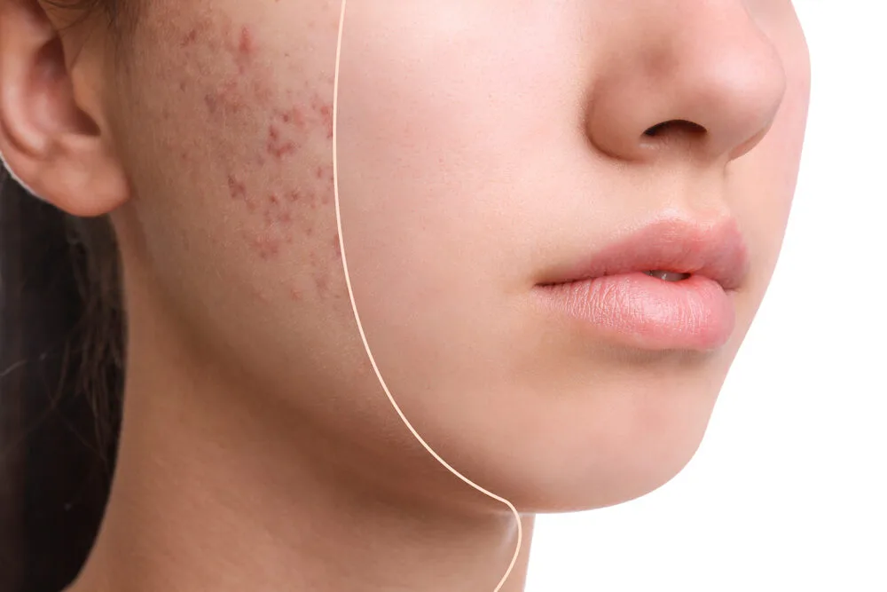 Facial Acne Scar Treatment