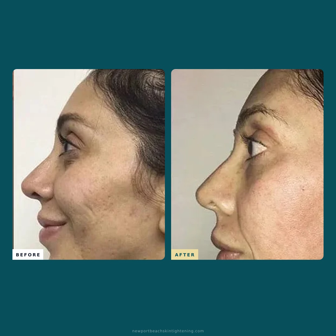 Square composite — Before and After