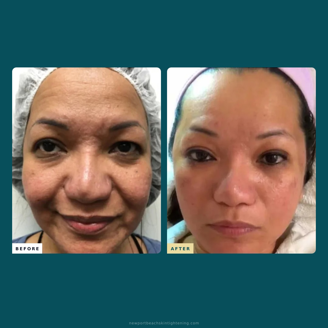 Square composite — Before and After