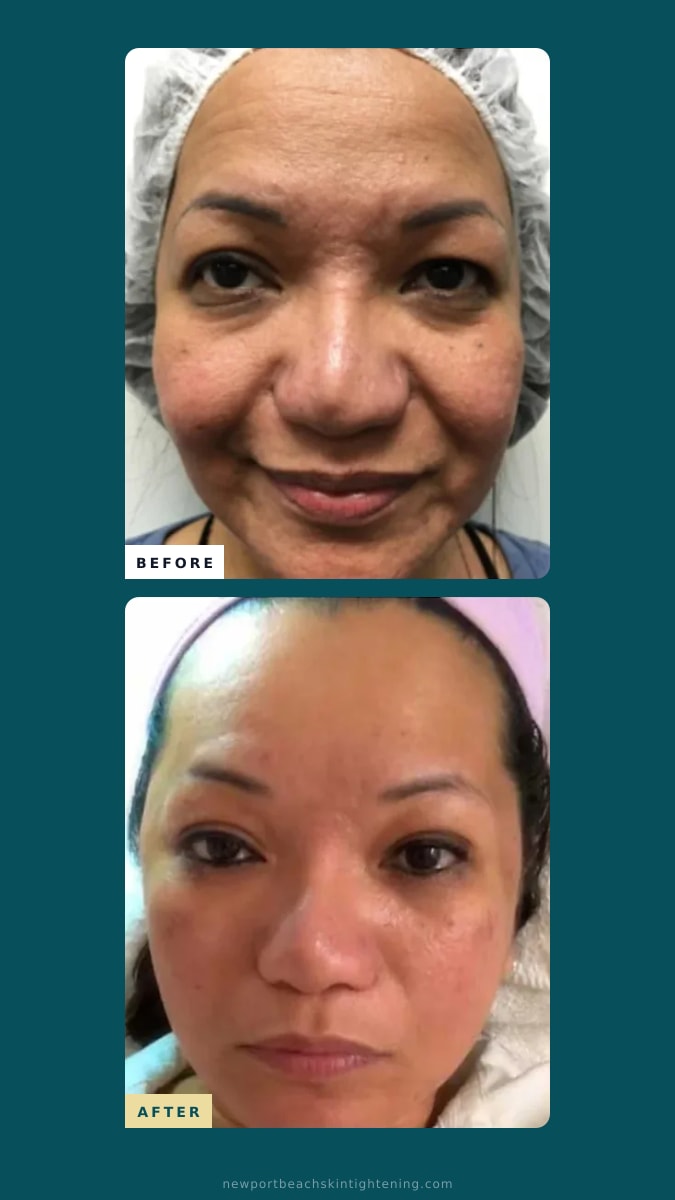 Stories / Reels composite — Before and After