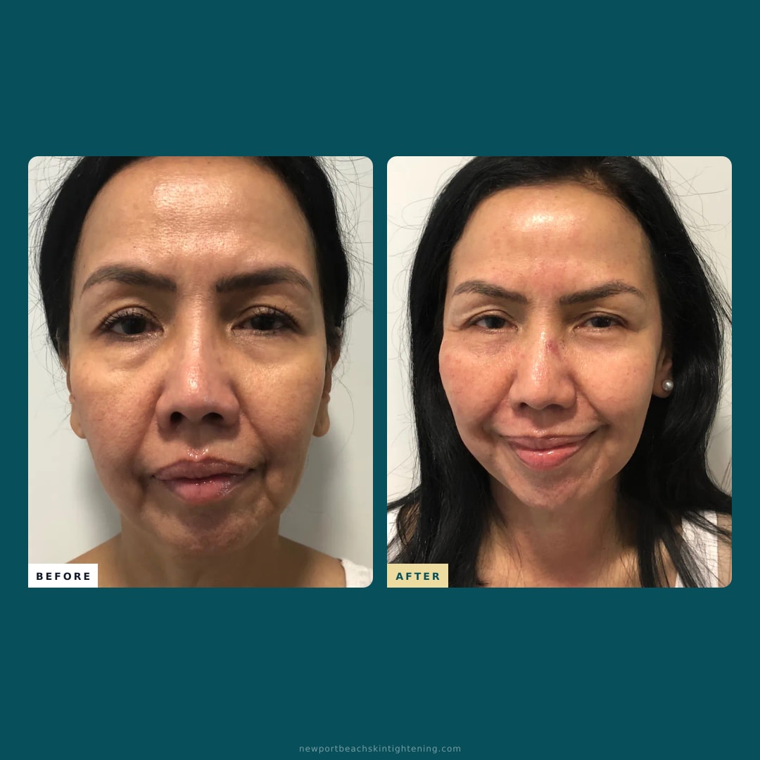 Square composite — Before and After