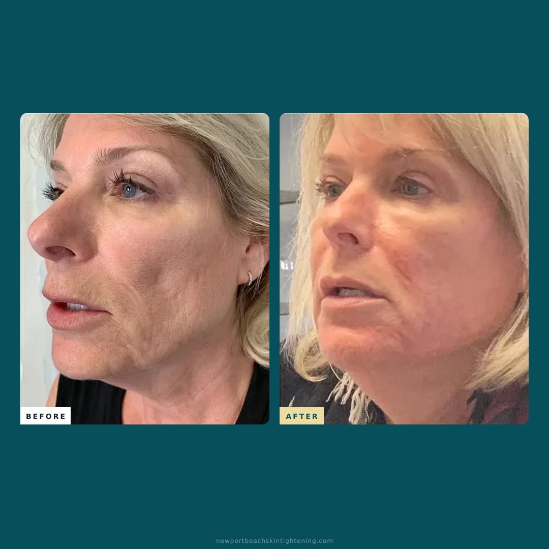 Square composite — Before and After
