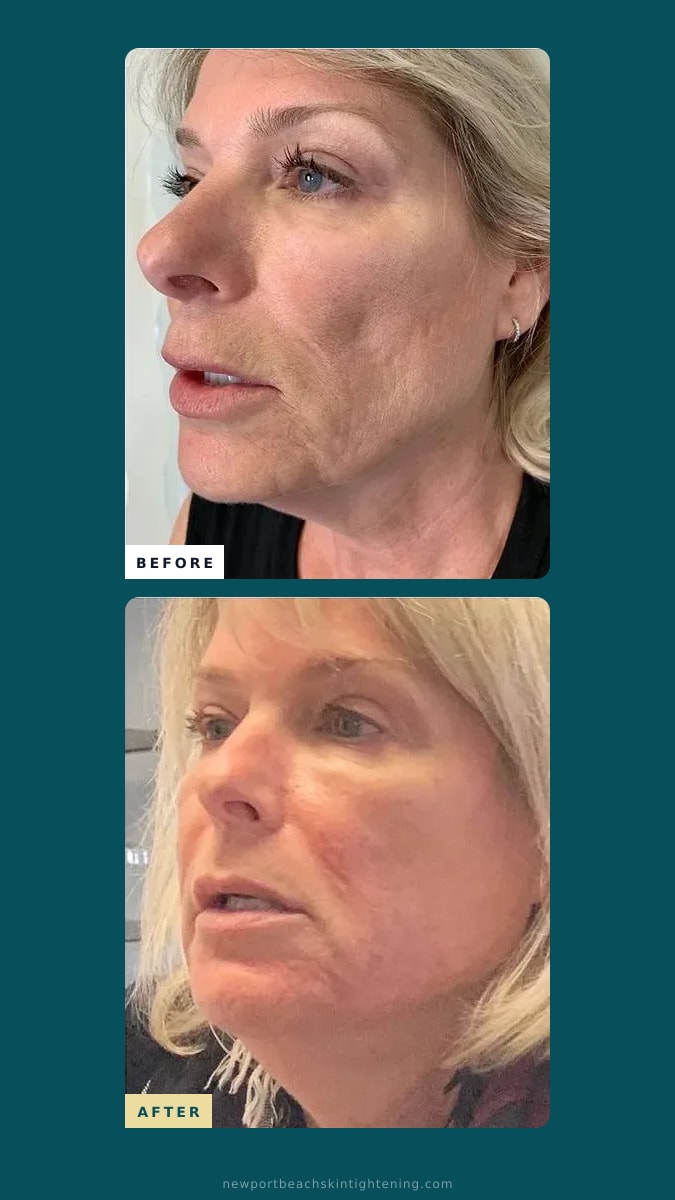 Stories / Reels composite — Before and After