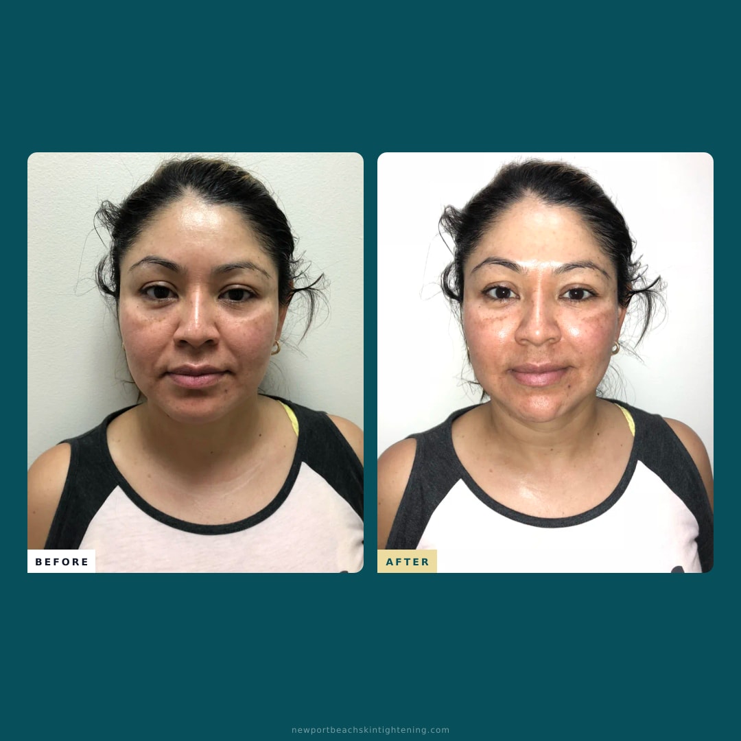 Square composite — Before and After