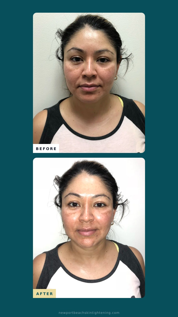 Stories / Reels composite — Before and After