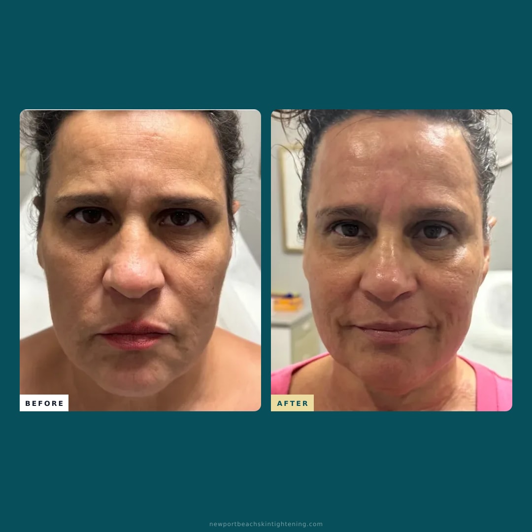 Square composite — Before and After