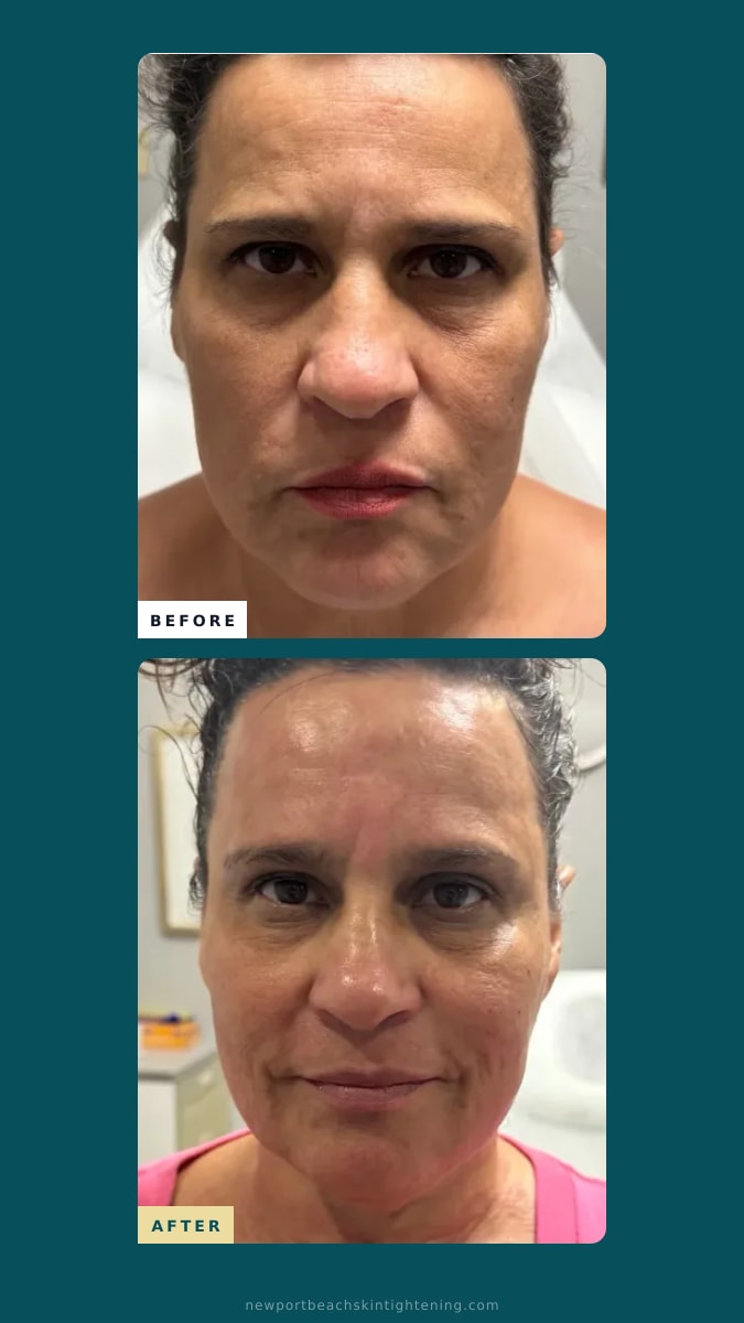Stories / Reels composite — Before and After